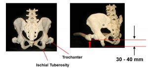 Figure 2. The anatomical relationship between the Ischial Tuberosities and the Trochanters image